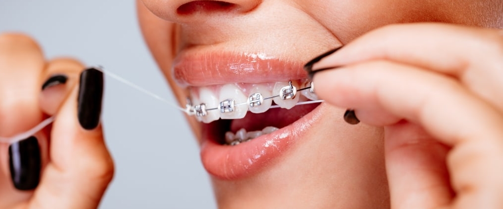 Eine Frau reinigt ihre Metallbrackets mit Zahnseide