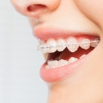 Junge Frau lächelt mit Keramikbrackets