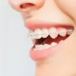 Junge Frau lächelt mit Keramikbrackets