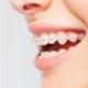 Junge Frau lächelt mit Keramikbrackets