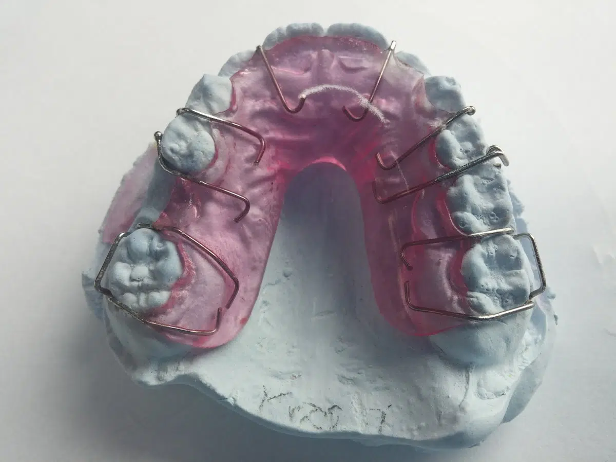 Eine pinke passive Spange liegt in einem Gipsabdruck