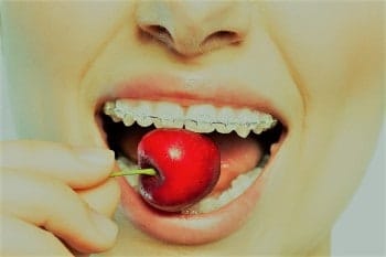 Zahn­spange mit Keramikbrackets