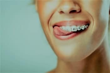 lächelnde Dame mit fester Spange mit Metallbrackets