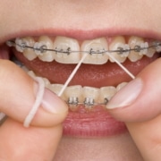 Reinigung der Brackets zur Vermeidung von Karies