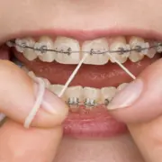 Reinigung der Brackets zur Vermeidung von Karies