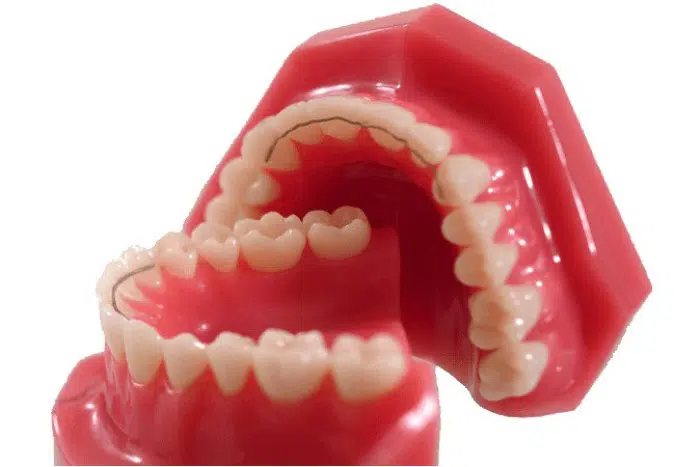 nach der erfolgreichen Zahnstellungskorrektur wird das Behandlungsergebnis mit Hilfe eines Retainers und einer Stabilisierungsschiene stabilisiert