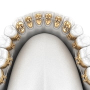 Zahnspangenwachs - Die hochwertigsten Zahnspangenwachs ausführlich verglichen!