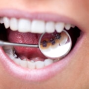 innenliegende feste Zahnspange einer jungen Frau wird über einen Mundspiegel gezeigt