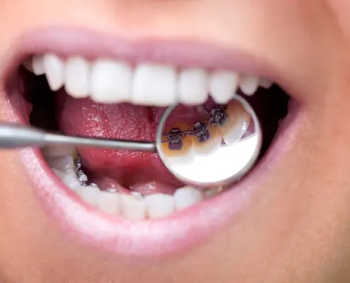 innenliegende feste Zahnspange einer jungen Frau wird über einen Mundspiegel gezeigt