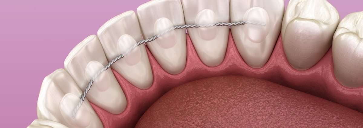 3D-Ansicht von Retainer