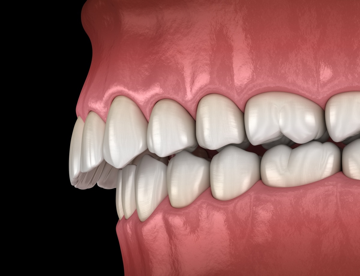 3D-Ansicht Ueberbiss
