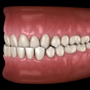 3D-Ansicht Unterbiss