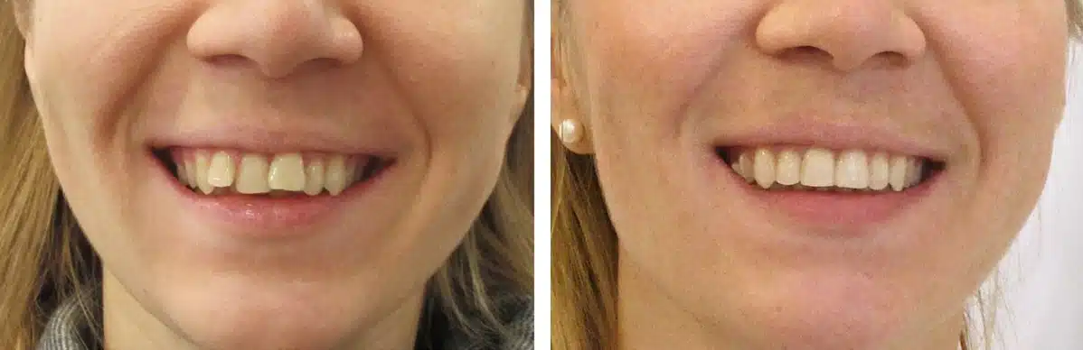 Eine Foto-Collage zum Thema schiefe Zähne: links die Ausgangssituation, rechts das Behandlungsergebnis nach der kieferorthopädischen Behandlung.