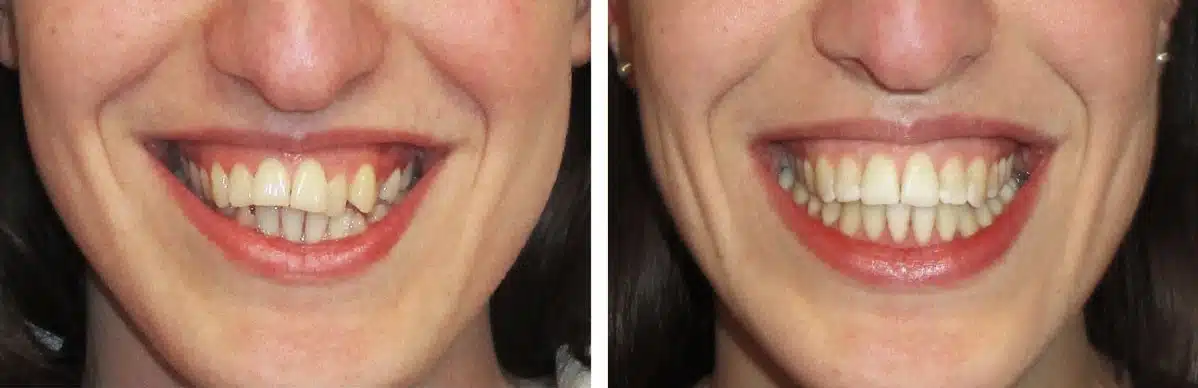 Eine Foto-Collage zum Thema gekippte Zähne: links die Ausgangssituation, rechts das Behandlungsergebnis nach der kieferorthopädischen Behandlung.