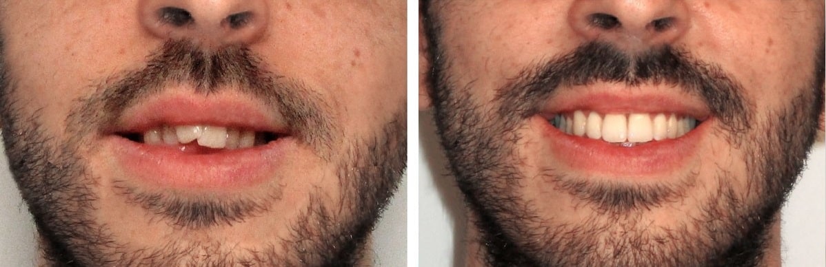 Eine Foto-Collage zum Thema Zahnengstand: links die Ausgangssituation, rechts das Behandlungsergebnis nach der kieferorthopädischen Behandlung.