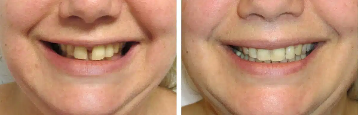 Eine Foto-Collage zum Thema Zahnlücke: links die Ausgangssituation, rechts das Behandlungsergebnis nach der kieferorthopädischen Behandlung.