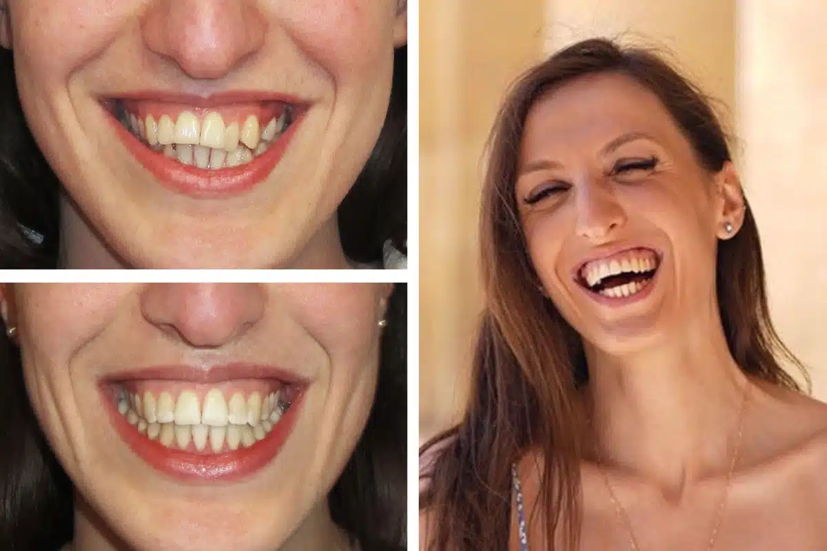 Eine Foto-Collage zum Thema gekippte Zähne: oben links die Ausgangssituation, unten links das Behandlungsergebnis nach der kieferorthopädischen Behandlung, rechts ein Foto des Patienten.