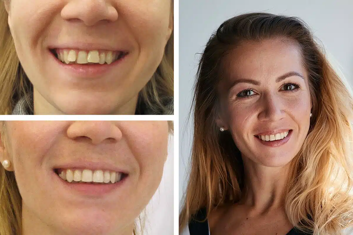 Eine Foto-Collage zum Thema schiefe Zähne: oben links die Ausgangssituation, unten links das Behandlungsergebnis nach der kieferorthopädischen Behandlung, rechts ein Foto des Patienten.