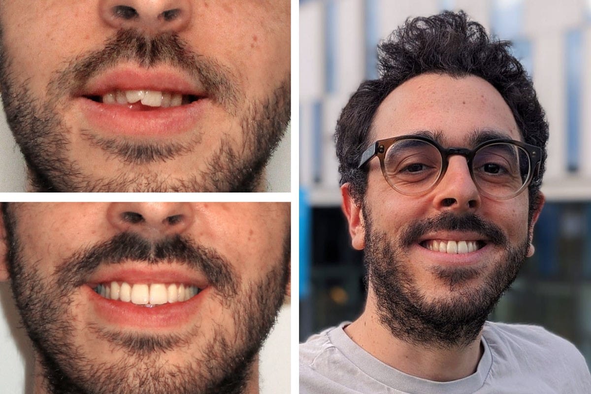 Eine Foto-Collage zum Thema Zahnengstand: oben links die Ausgangssituation, unten links das Behandlungsergebnis, rechts ein Foto des Patienten.