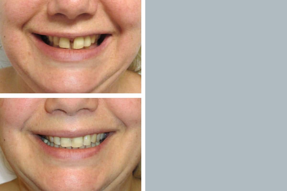 Eine Foto-Collage zum Thema Zahnlücke: oben links die Ausgangssituation, unten links das Behandlungsergebnis, rechts ein Foto des Patienten.