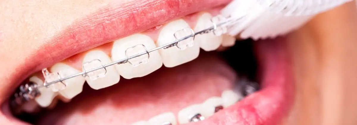 Keramikbrackets werden mit Zahnbürste gereinigt