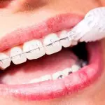 Keramikbrackets werden mit Zahnbürste gereinigt