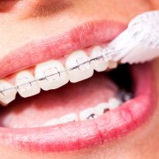 Keramikbrackets werden mit Zahnbürste gereinigt